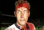 Terry Butcher com sangue